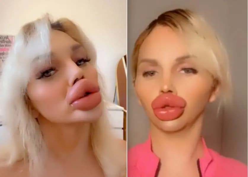 15 000 евро! Именно столько тратит Instagram-звезда Vienna Würstl на свои губы